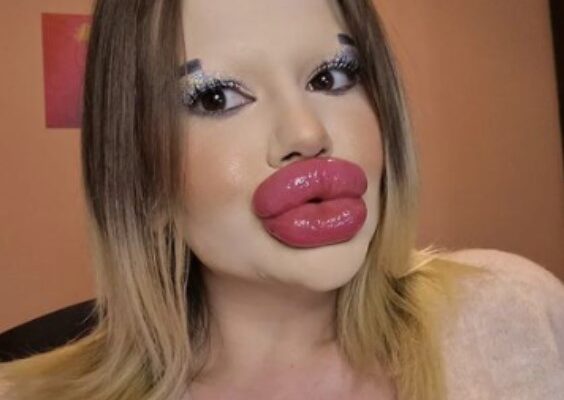 The Woman With the World’s Biggest Lips Has Trouble Finding Love